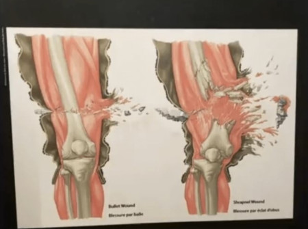 The difference between a bullet and a shrapnel wound