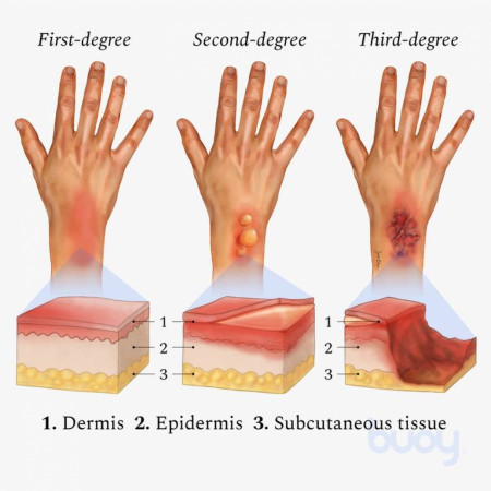 Classification of Burns - the three degrees