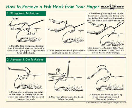 How Remove a Fish Hook From Your Finger (safely and painlessly)