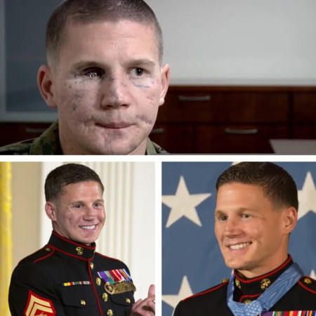 Medal Of Honor recipient Kyle Carpenter before and after facial reconstruction surgery