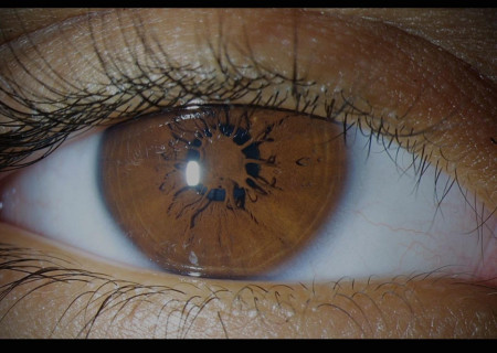 Persistent pupillary membrane