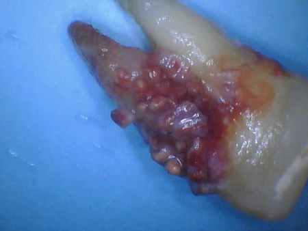 Calculus (tartar) build up on a tooth I recently extracted