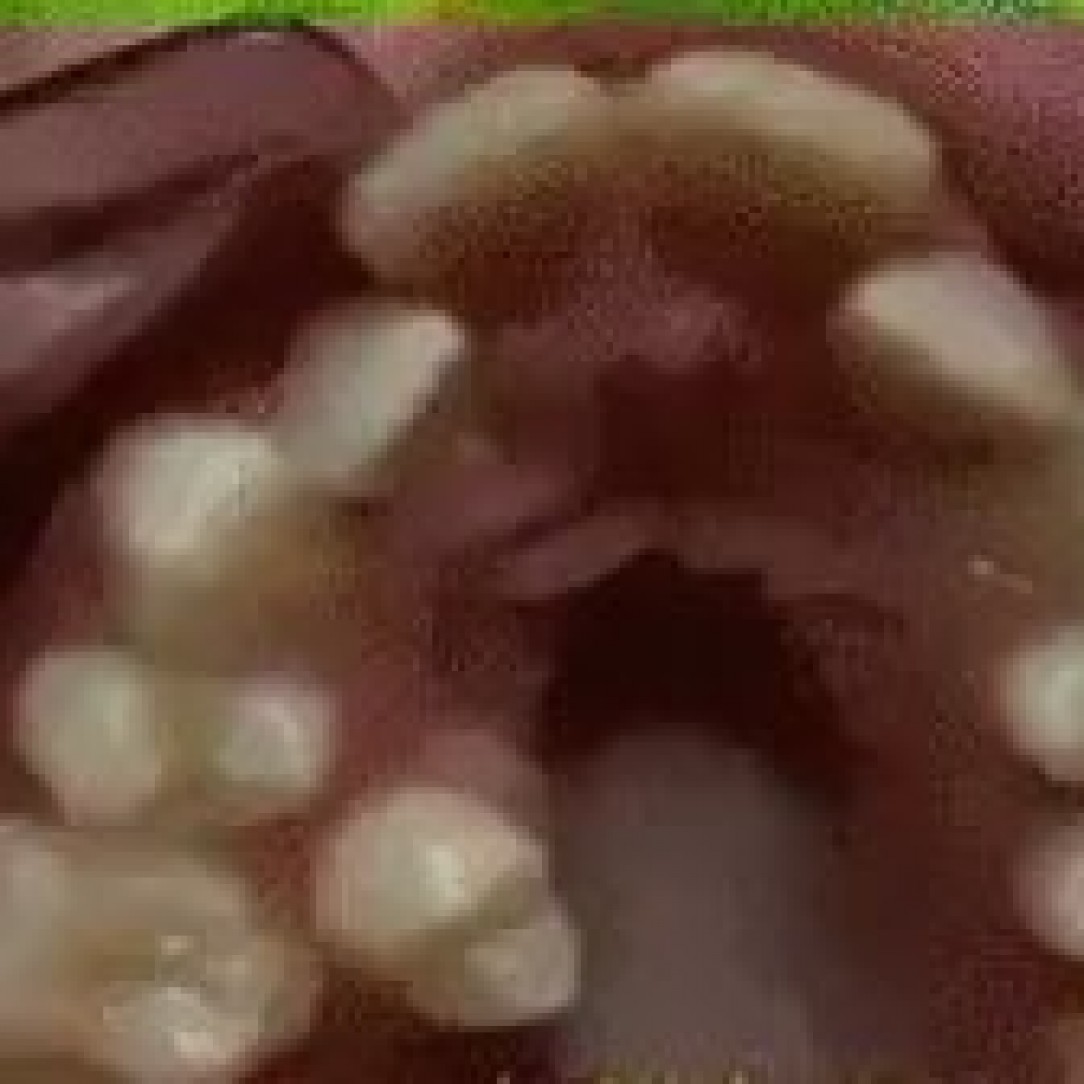 How braces change teeth (Time-lapse) .