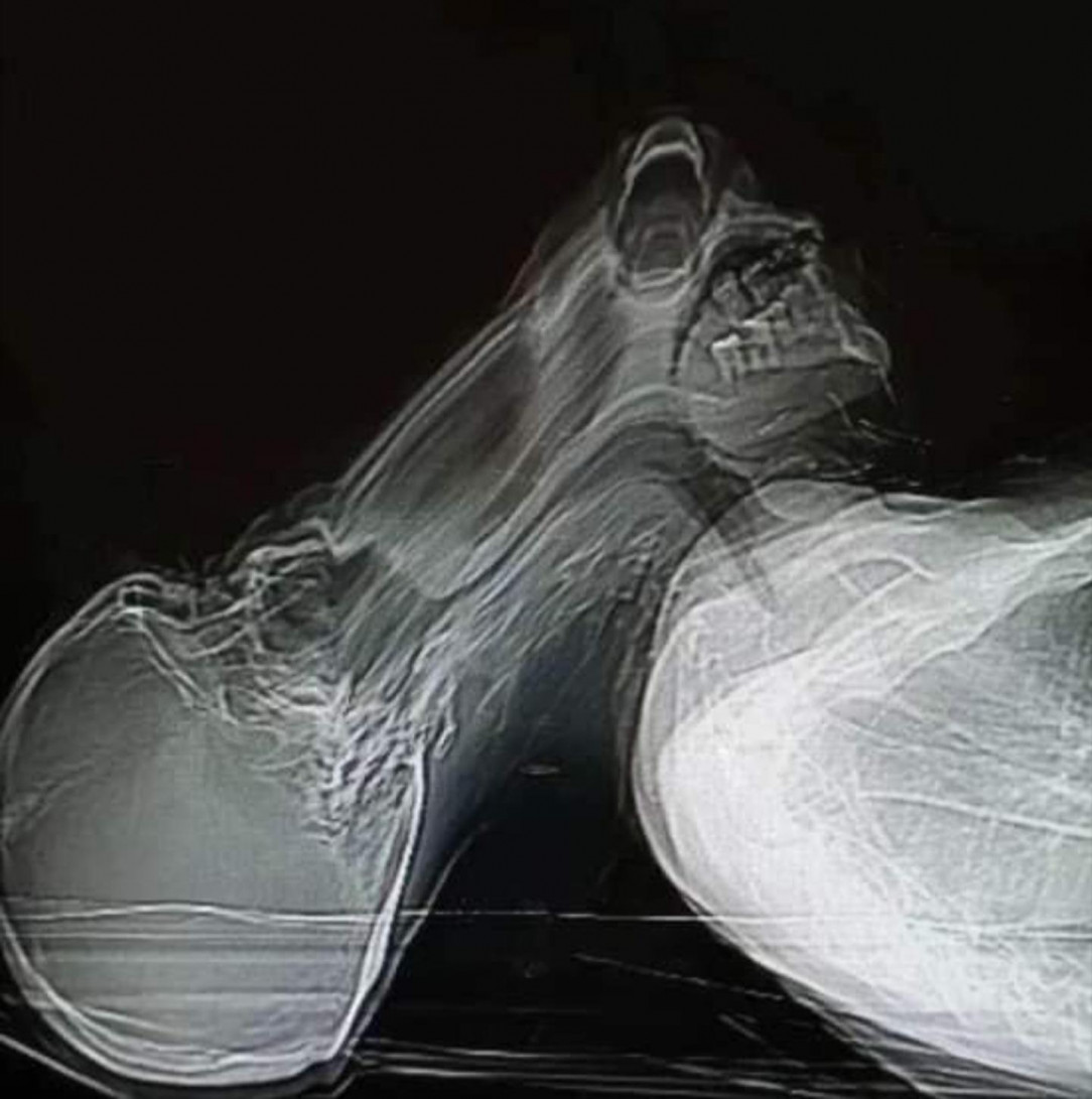 a claustrophobic person moving during their CT scan