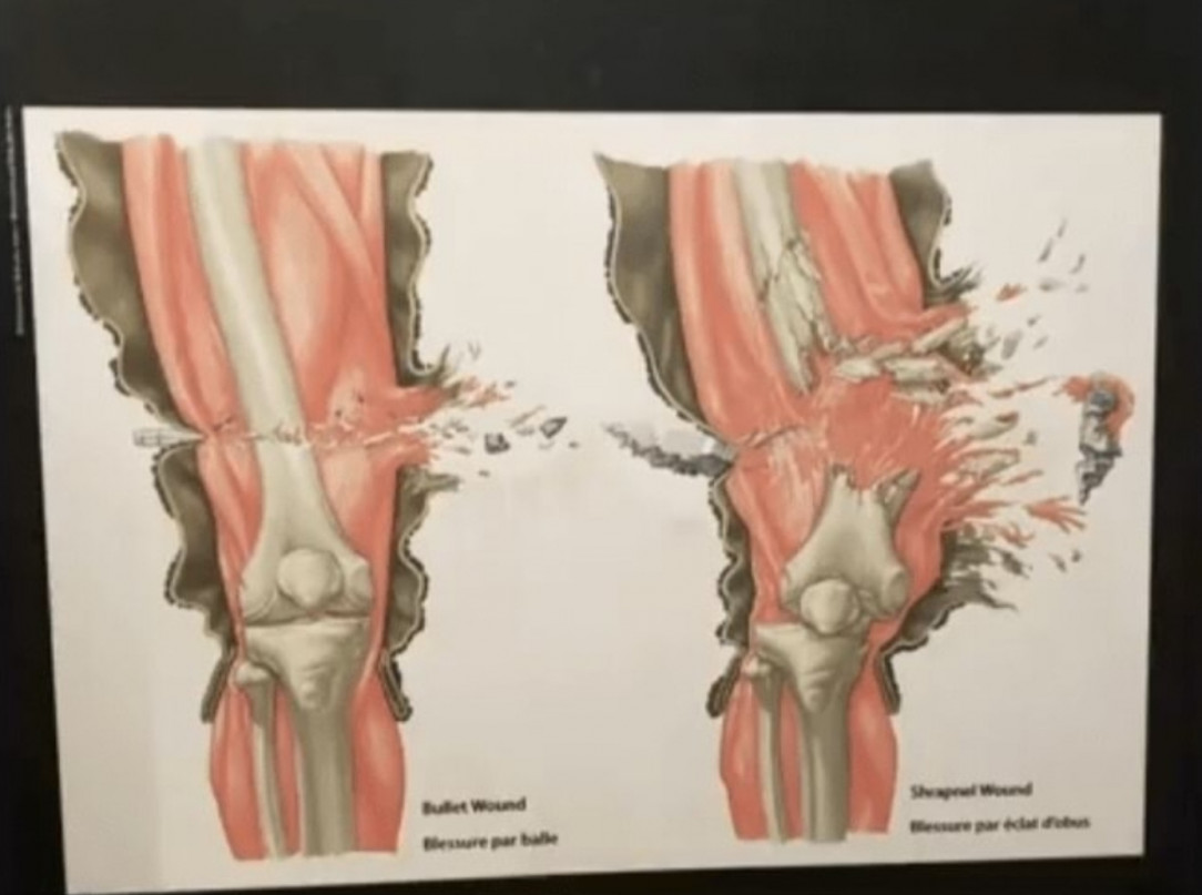 The difference between a bullet and a shrapnel wound