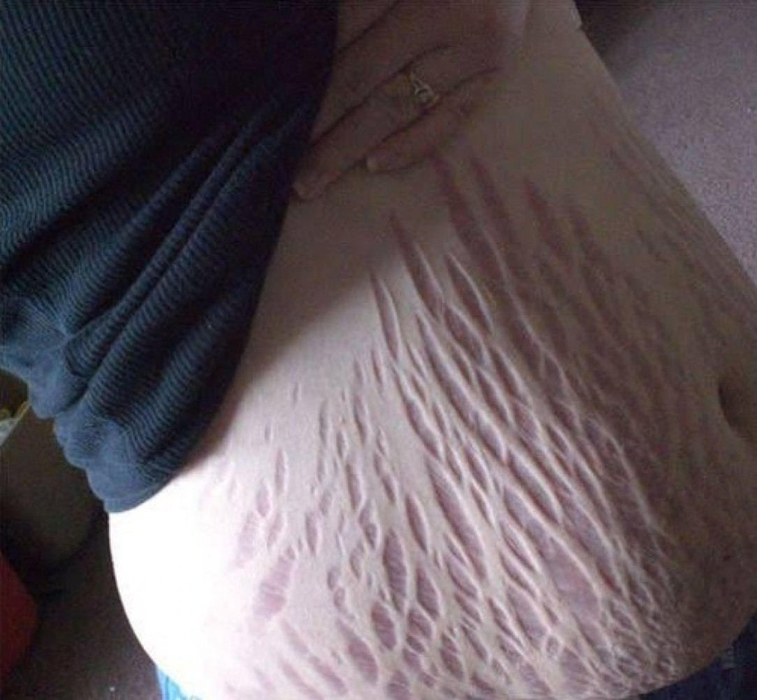 Insane stretch marks