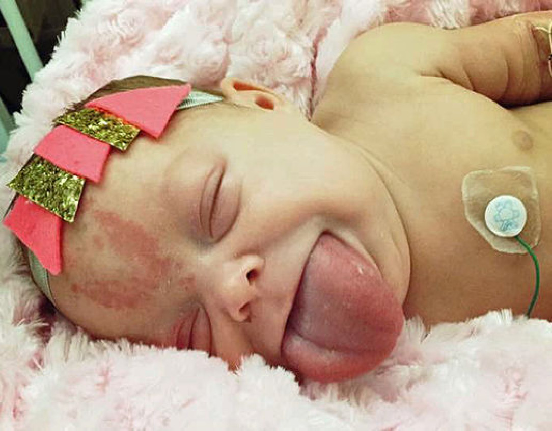 Baby born with Beckwith-Wiedemann syndrome, adult sized tounge