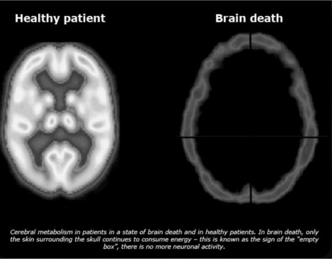 The difference in brain scans between a healthy and a brain dead patient