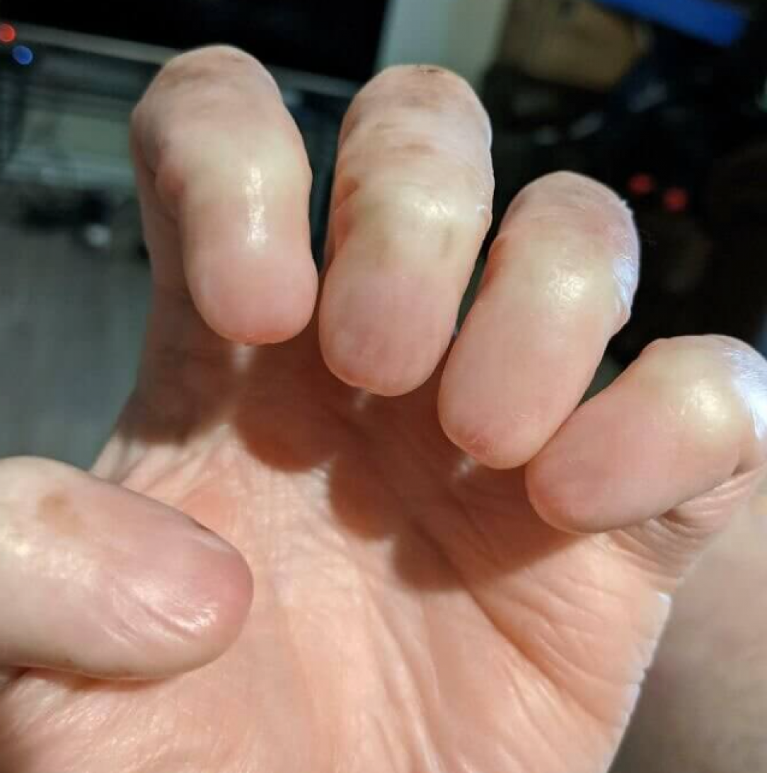 People born with Anonychia do not have fingernails and cannot grow them