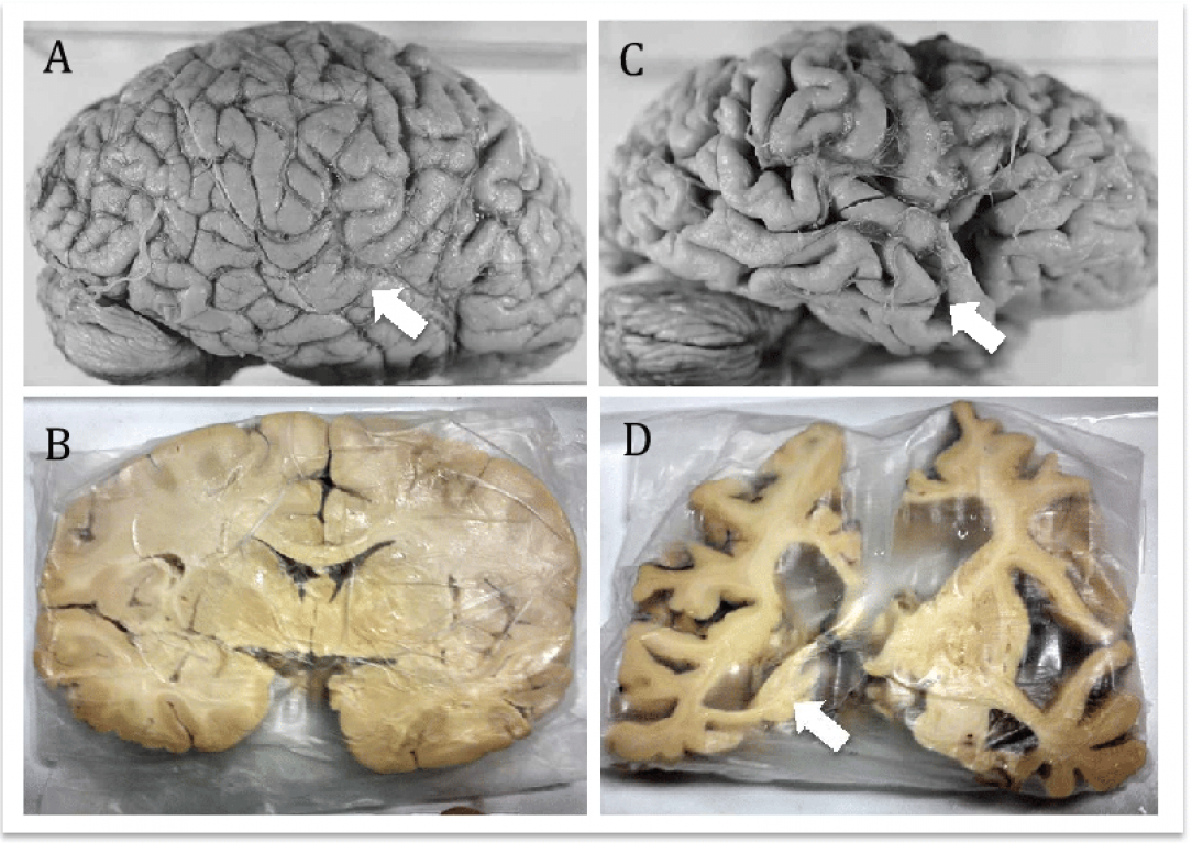 Neuroanatomical comparison of normal brain and Alzheimer´s disease brain