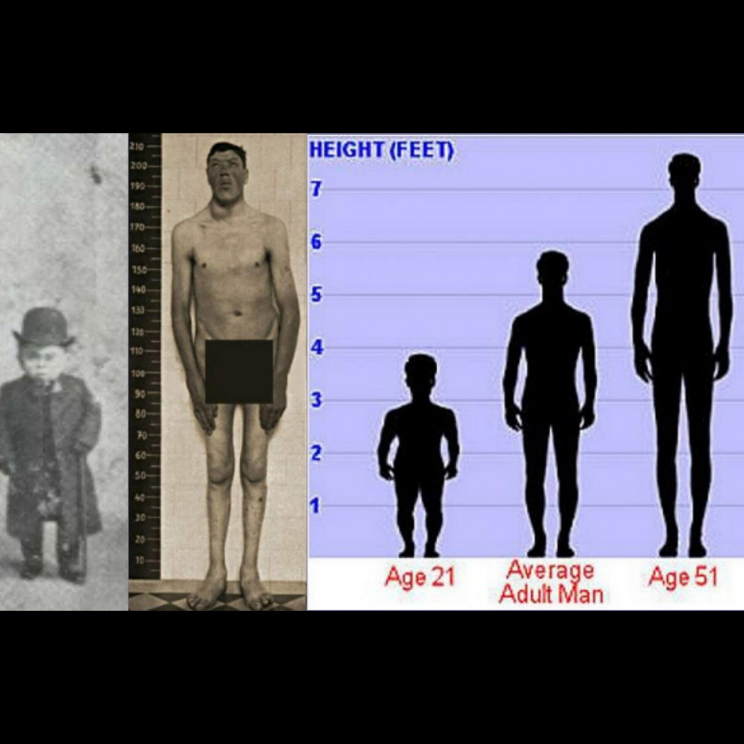 Adam Rainer was the only person in recorded history to have been both a dwarf and a giant in one lifetime