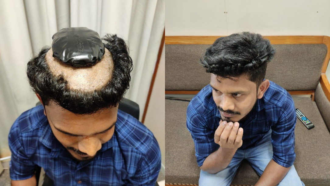 A man was caught trying to smuggle 1kg of gold in a compound form under his wig but was caught at Kochi Airport, Kerala