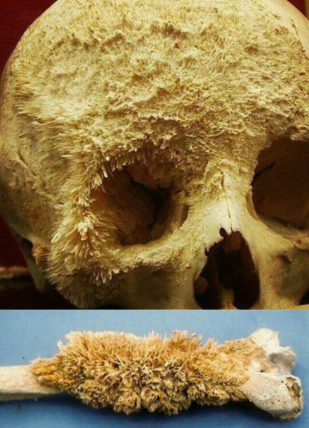 This is what a bone cancer looks like