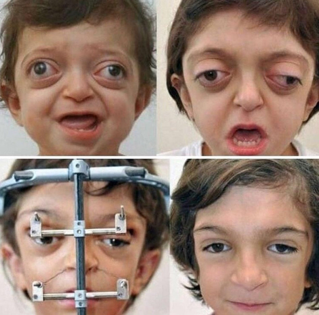 Facial reconstruction on a child with Crouzon Syndrome