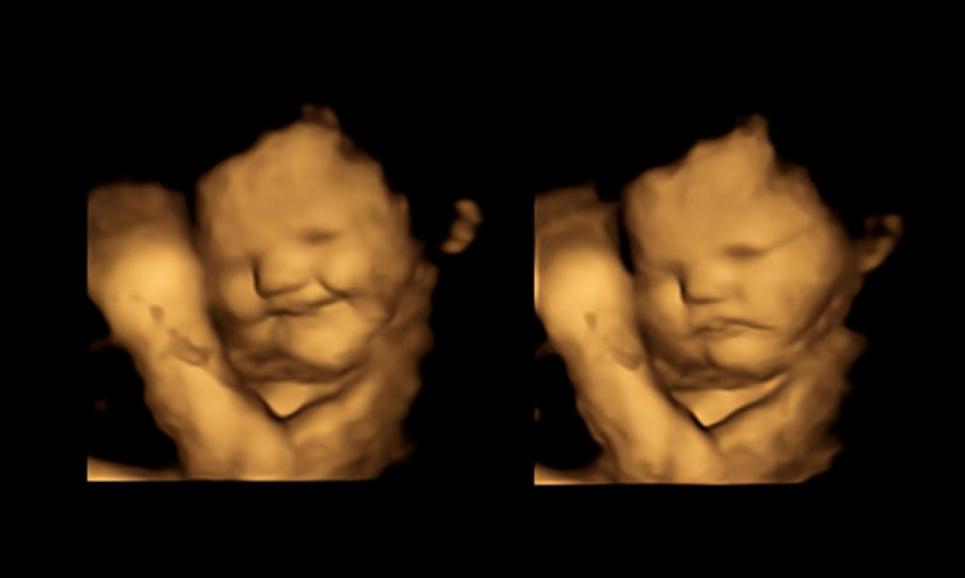 Images from the FETAP (Fetal Taste Preferences) study show a reaction to carrots on the left, compared to a neutral face on the right