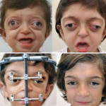 Facial reconstruction on a child with Crouzon Syndrome